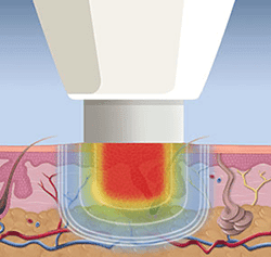 Treatment process